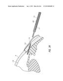 INTRAOCULAR SHUNT IMPLANTATION diagram and image