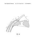 INTRAOCULAR SHUNT IMPLANTATION diagram and image