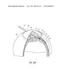 INTRAOCULAR SHUNT IMPLANTATION diagram and image