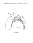 INTRAOCULAR SHUNT IMPLANTATION diagram and image