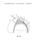 INTRAOCULAR SHUNT IMPLANTATION diagram and image