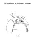 INTRAOCULAR SHUNT IMPLANTATION diagram and image