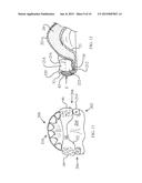 Oral Appliance and Tray diagram and image