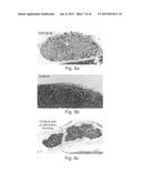 Disease treatment via developing non-syngeneic graft transplantation diagram and image