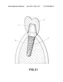 DENTAL POST FOR SUPPORTING DENTAL PROSTHESES AND METHOD FOR THE PRODUCTION     THEREOF diagram and image