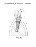 DENTAL POST FOR SUPPORTING DENTAL PROSTHESES AND METHOD FOR THE PRODUCTION     THEREOF diagram and image