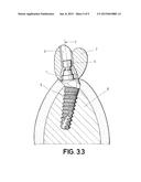 DENTAL POST FOR SUPPORTING DENTAL PROSTHESES AND METHOD FOR THE PRODUCTION     THEREOF diagram and image