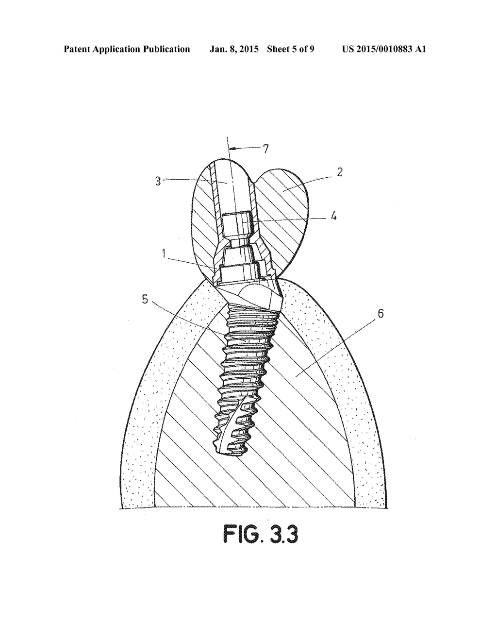 DENTAL POST FOR SUPPORTING DENTAL PROSTHESES AND METHOD FOR THE PRODUCTION     THEREOF - diagram, schematic, and image 06