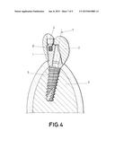 DENTAL POST FOR SUPPORTING DENTAL PROSTHESES AND METHOD FOR THE PRODUCTION     THEREOF diagram and image