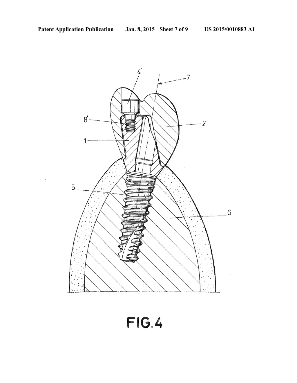 DENTAL POST FOR SUPPORTING DENTAL PROSTHESES AND METHOD FOR THE PRODUCTION     THEREOF - diagram, schematic, and image 08