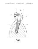 DENTAL POST FOR SUPPORTING DENTAL PROSTHESES AND METHOD FOR THE PRODUCTION     THEREOF diagram and image