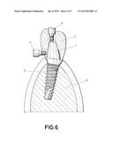 DENTAL POST FOR SUPPORTING DENTAL PROSTHESES AND METHOD FOR THE PRODUCTION     THEREOF diagram and image