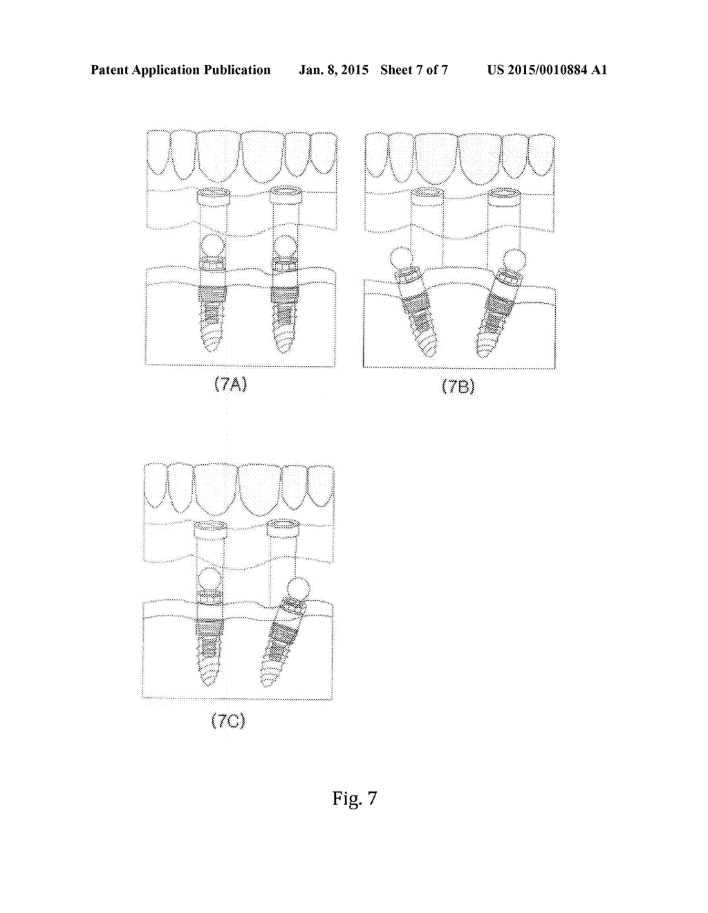 DENTURE-FIXING ATTACHMENT HAVING FREELY ADJUSTABLE ANGLE AND POSITION - diagram, schematic, and image 08