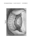 DENTAL PROSTHESIS AND METHOD OF ITS PRODUCTION UTILIZING STANDARDIZED     FRAMEWORK KEYS AND MATCHING PREMANUFACTURED TEETH diagram and image