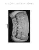 DENTAL PROSTHESIS AND METHOD OF ITS PRODUCTION UTILIZING STANDARDIZED     FRAMEWORK KEYS AND MATCHING PREMANUFACTURED TEETH diagram and image