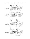 CONTROLLED SYMPATHECTOMY AND MICRO-ABLATION SYSTEMS AND METHODS diagram and image