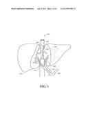 HEPATIC NEUROMODULATION USING MICROWAVE ENERGY diagram and image