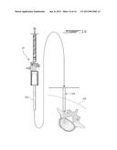 DEVICE FOR INJECTING HIGH VISCOSITY MATERIAL diagram and image