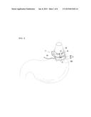 GASTRIC BAND SECURING DEVICE AND GASTRIC BAND COMPRISING SAME diagram and image