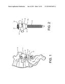 PEDICLE SCREW EXTENSION FOR USE IN PERCUTANEOUS SPINAL FIXATION diagram and image