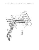 PEDICLE SCREW EXTENSION FOR USE IN PERCUTANEOUS SPINAL FIXATION diagram and image