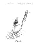 PEDICLE SCREW EXTENSION FOR USE IN PERCUTANEOUS SPINAL FIXATION diagram and image