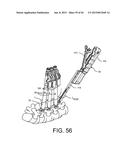 PEDICLE SCREW EXTENSION FOR USE IN PERCUTANEOUS SPINAL FIXATION diagram and image