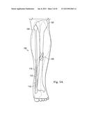 Neurostimulator Configured to Sense Evoked Potentials in Peripheral Nerves diagram and image