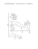 Neurostimulator Configured to Sense Evoked Potentials in Peripheral Nerves diagram and image