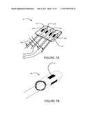 TRANSVASCULAR NERVE STIMULATION APPARATUS AND METHODS diagram and image