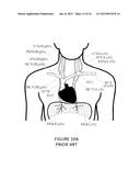 TRANSVASCULAR NERVE STIMULATION APPARATUS AND METHODS diagram and image