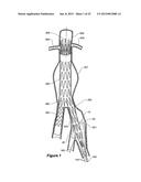 ENDOVASCULAR GRAFT HAVING A CANNULATION POCKET diagram and image