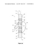 ENDOVASCULAR GRAFT HAVING A CANNULATION POCKET diagram and image