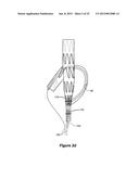 ENDOVASCULAR GRAFT HAVING A CANNULATION POCKET diagram and image