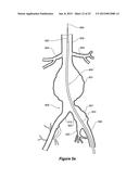 ENDOVASCULAR GRAFT HAVING A CANNULATION POCKET diagram and image