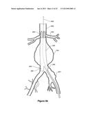 ENDOVASCULAR GRAFT HAVING A CANNULATION POCKET diagram and image