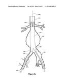 ENDOVASCULAR GRAFT HAVING A CANNULATION POCKET diagram and image