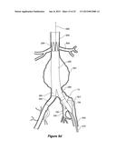 ENDOVASCULAR GRAFT HAVING A CANNULATION POCKET diagram and image