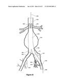 ENDOVASCULAR GRAFT HAVING A CANNULATION POCKET diagram and image