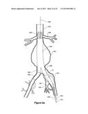 ENDOVASCULAR GRAFT HAVING A CANNULATION POCKET diagram and image