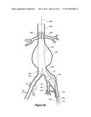 ENDOVASCULAR GRAFT HAVING A CANNULATION POCKET diagram and image