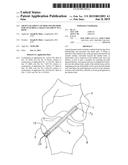 GRAFT LIGAMENT ANCHOR AND METHOD FOR ATTACHING A GRAFT LIGAMENT TO A BONE diagram and image