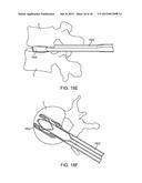 METHODS AND APPARATUS FOR IMPLANTING AN INTERBODY DEVICE diagram and image