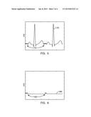 METHOD AND SYSTEM FOR ANALYZING NOISE IN AN ELECTROPHYSIOLOGY STUDY diagram and image