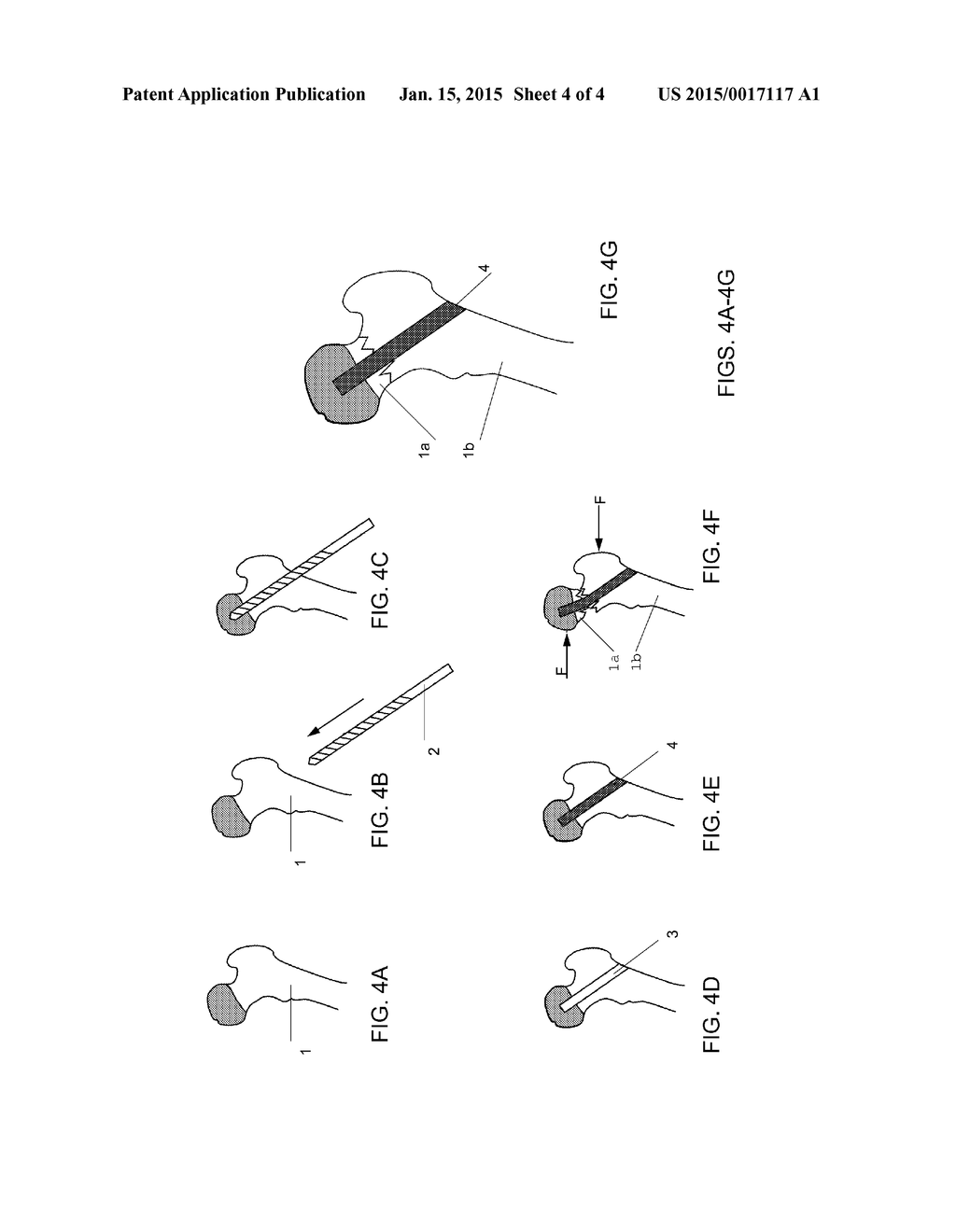 Composition for In Vivo Vessel Repair - diagram, schematic, and image 05