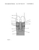 Knee spacer system with adjustable separator diagram and image