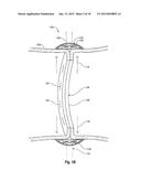 DETECTING LEAKAGE FROM AN INTERNAL SURGICAL SITE diagram and image