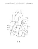 DETECTING LEAKAGE FROM AN INTERNAL SURGICAL SITE diagram and image