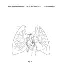 METHODS AND APPARATUS FOR TREATING PULMONARY EMBOLISM diagram and image