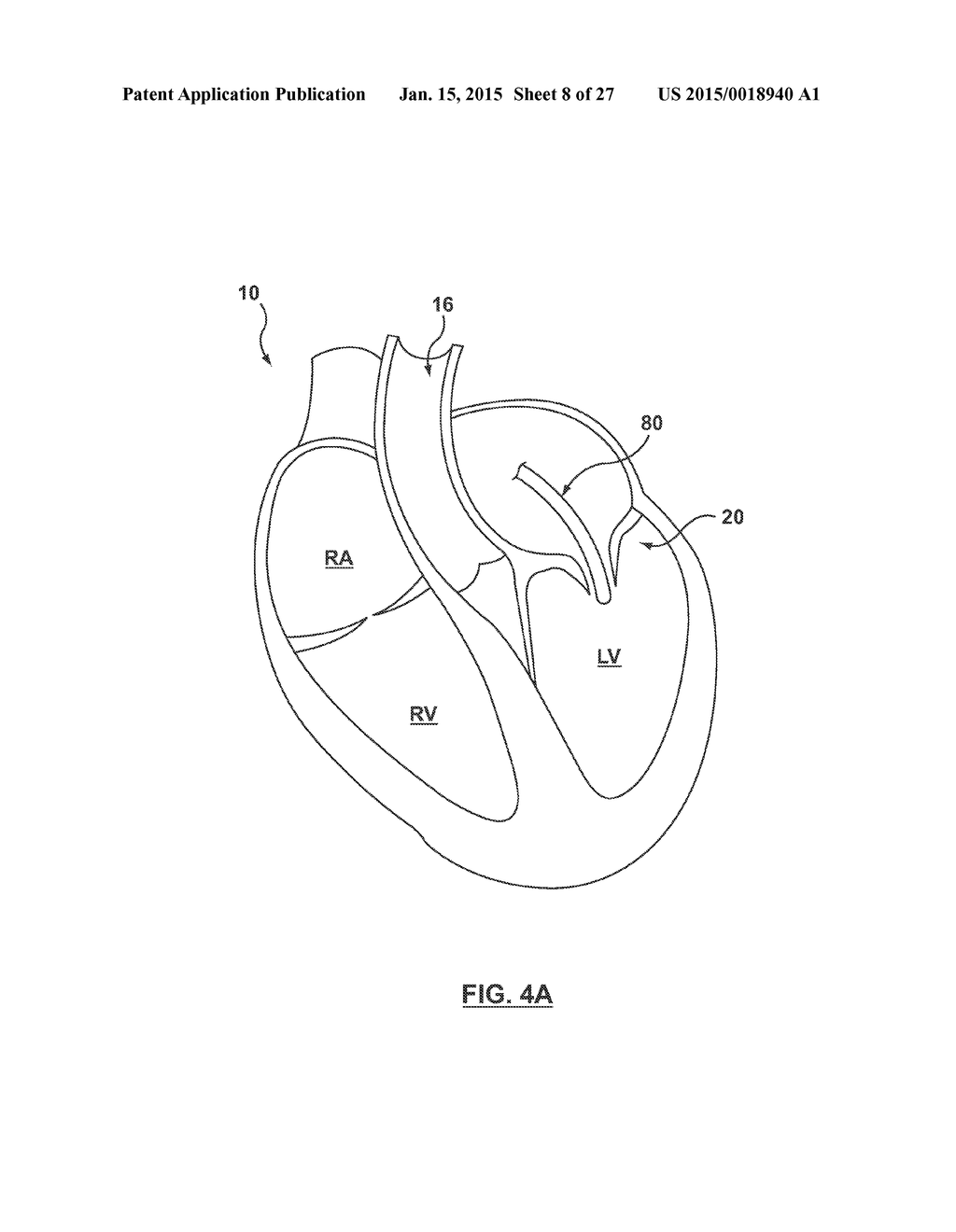 HELICAL COIL MITRAL VALVE ANNULOPLASTY SYSTEMS AND METHODS - diagram, schematic, and image 09